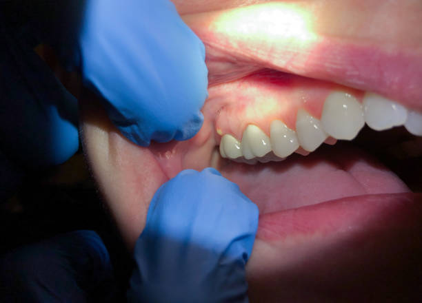 Best Tooth Infection Emergency Dentist  in Borger, TX